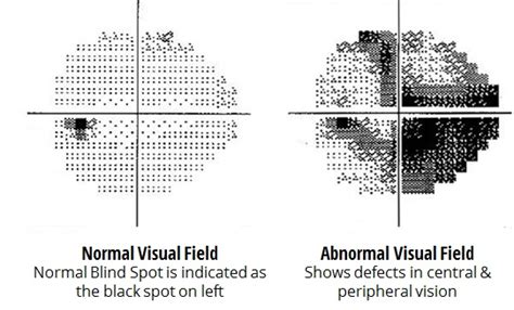abnormal visual field test results|Visual Field Test: What It Is and What the Results Mean.